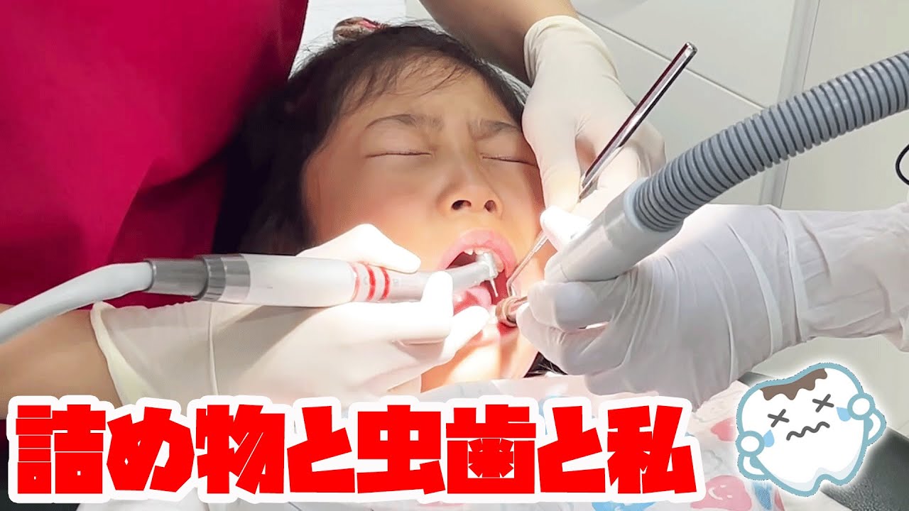 【歯医者さん】詰め物が取れたので歯医者に行ったら・・・虫歯も見つかった！！　dentist toothdecay　ひめまるちゃんねる　　ひめまる