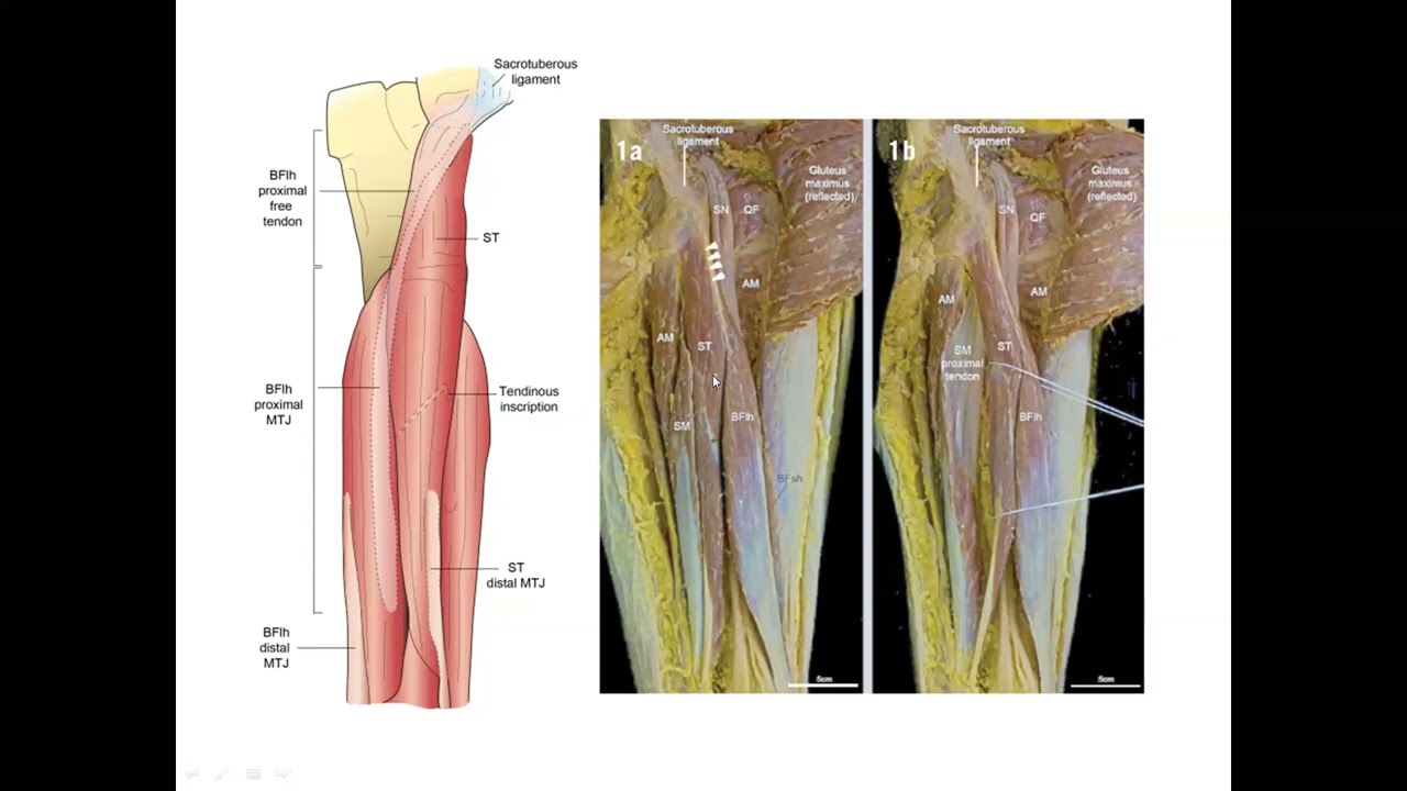 Hamstring Injuries and Return to Play Following Anterior Cruciate Ligament Repair - WFATT Webinar
