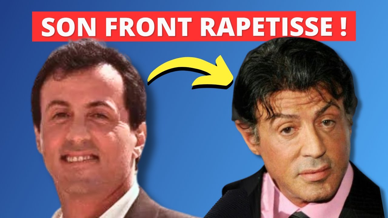 Vaincre la Calvitie - Ne Faites surtout pas comme Stallone 😱!