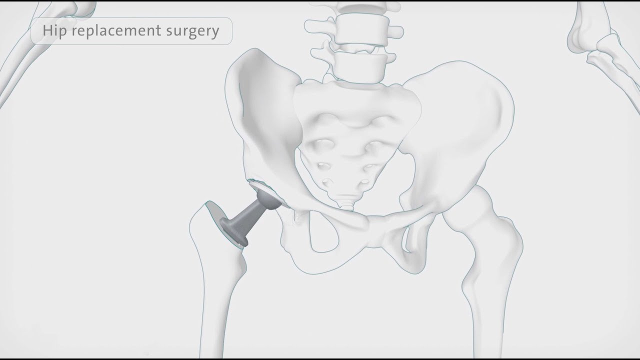How a hip replacement is performed | Spire Healthcare