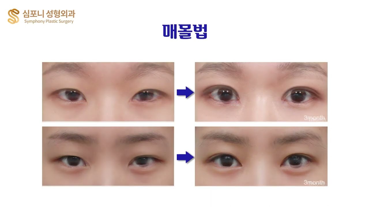 ★Double Eyelid Surgery : Before & After★ Symphony Plastic Surgery Korea - Non-incision/Incision