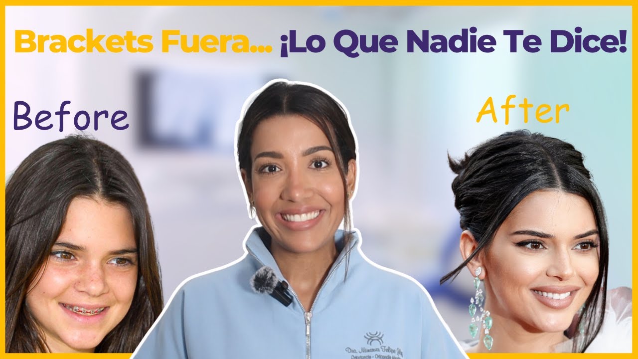 ¿Qué Sigue Después de Quitarme los Brackets?