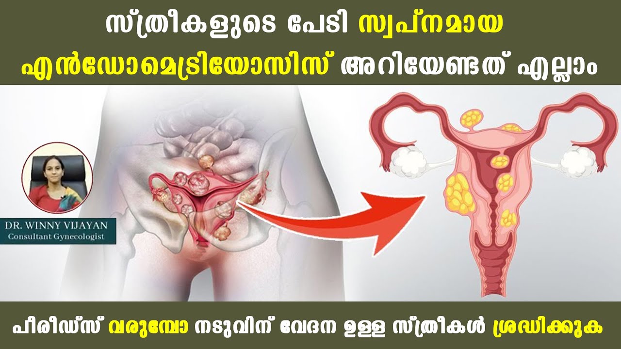 പീരീഡ്സ് വരുമ്പോ നടുവിന് വേദന ഉള്ള സ്ത്രീകൾ ശ്രദ്ധിക്കുക /Endometriosis /Baiju's Vlogs