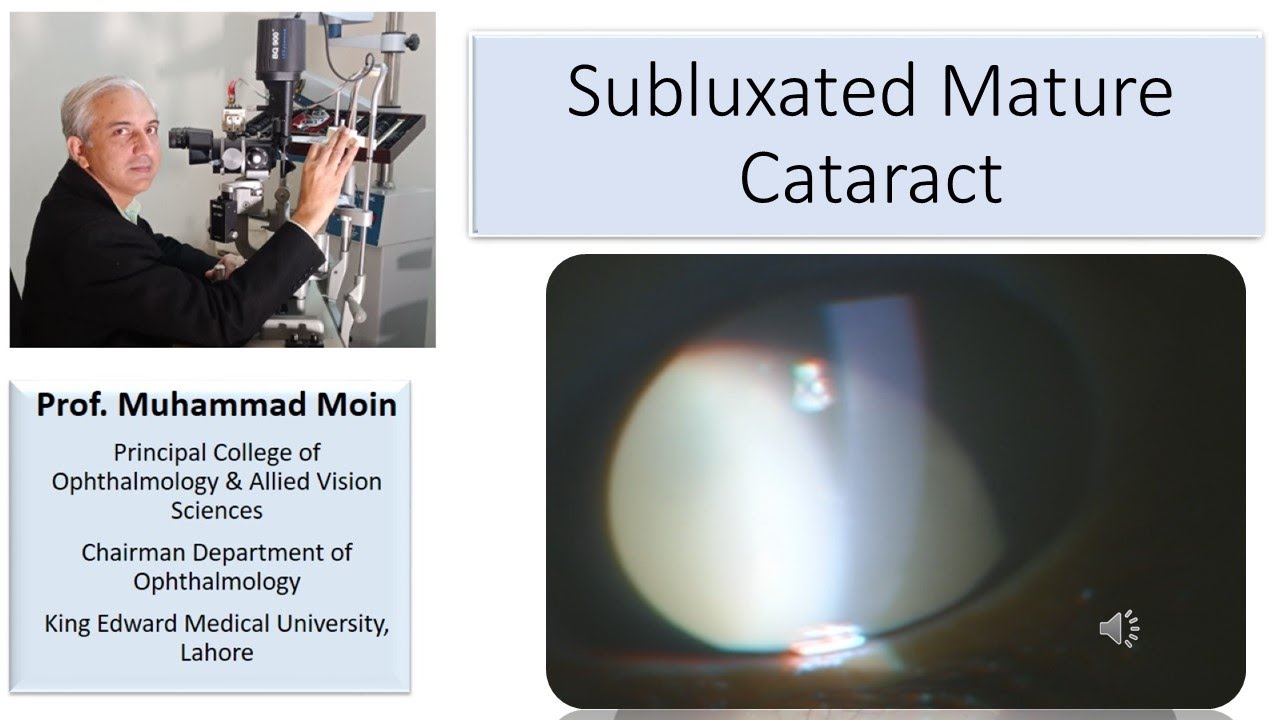 Subluxated Mature Cataract Surgery Options