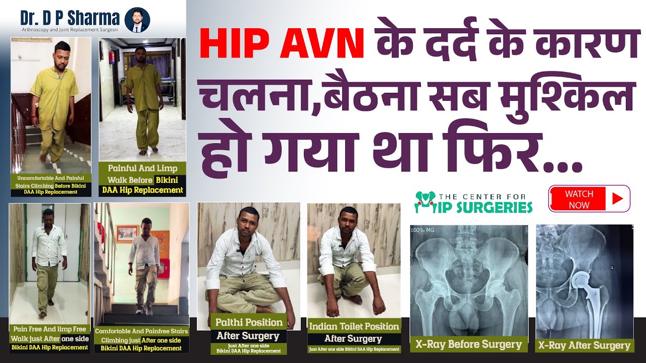 HIP AVN Treated By MIS BIKINI DAA Hip Replacement of Patient From Bihar In Delhi-NCR - Dr DP Sharma