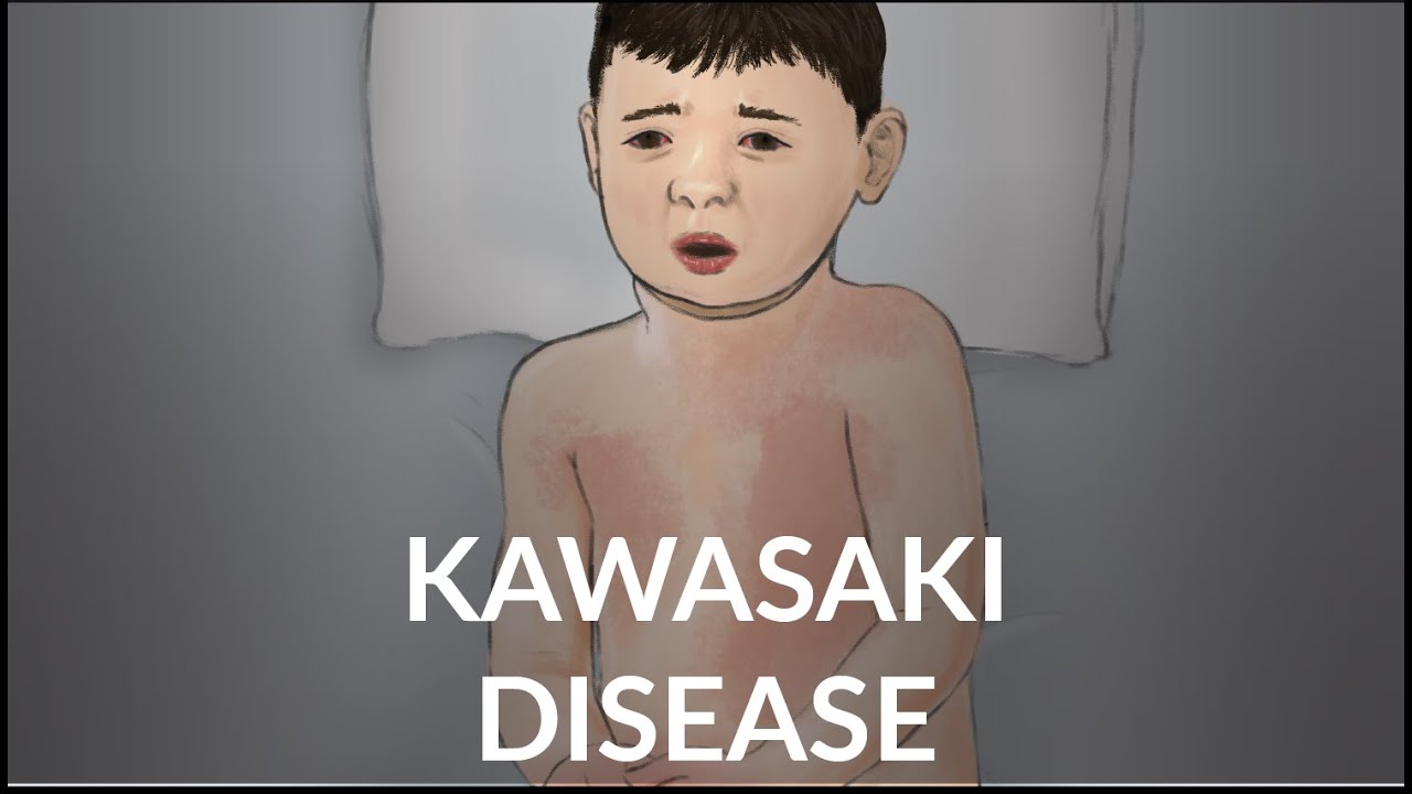 Болезнь Кавасаки, Л. Рубин, Л. ДиПьетро | OPENPediatrics