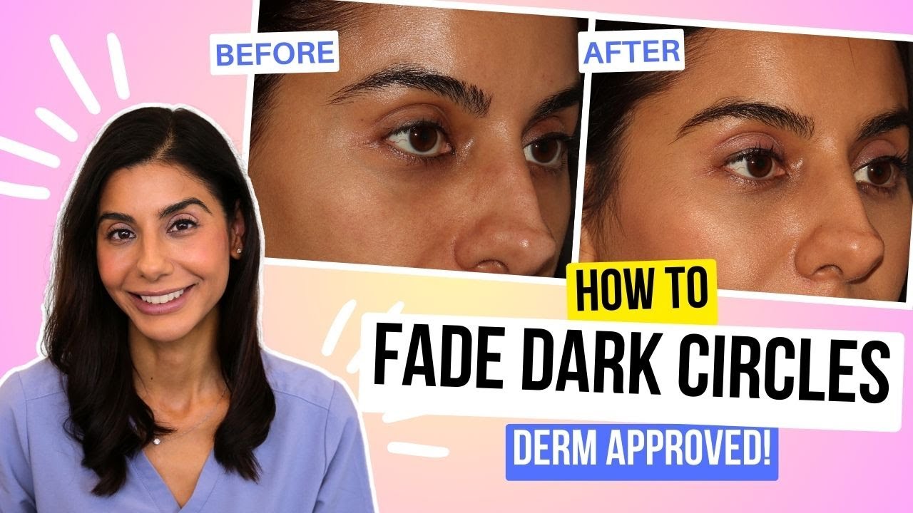 How to Fade Dark Circles! Dermatologist Explains PRFM Treatment