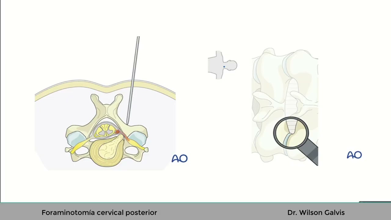 Foraminotomía cervical posterior