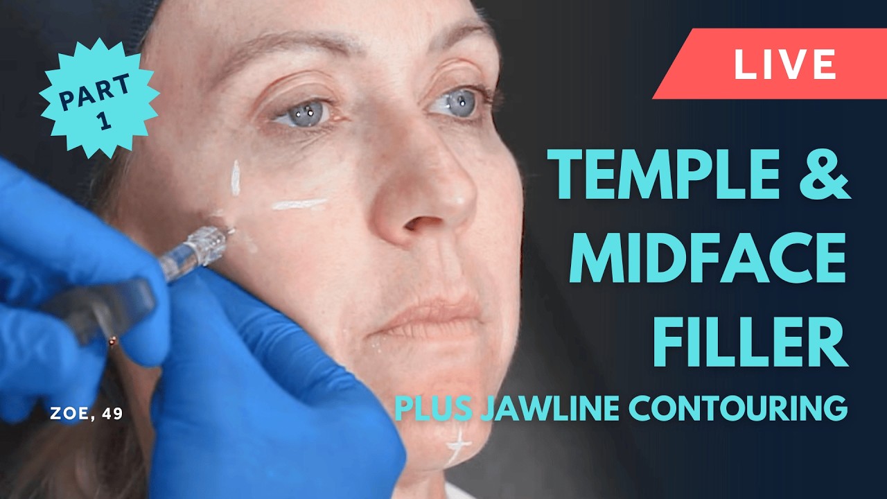 Live Temple Filler, Pyriform Fossa, Cheek Filler & Jawline Contouring 💎 GEM© Clinic - Zoe, Part 1
