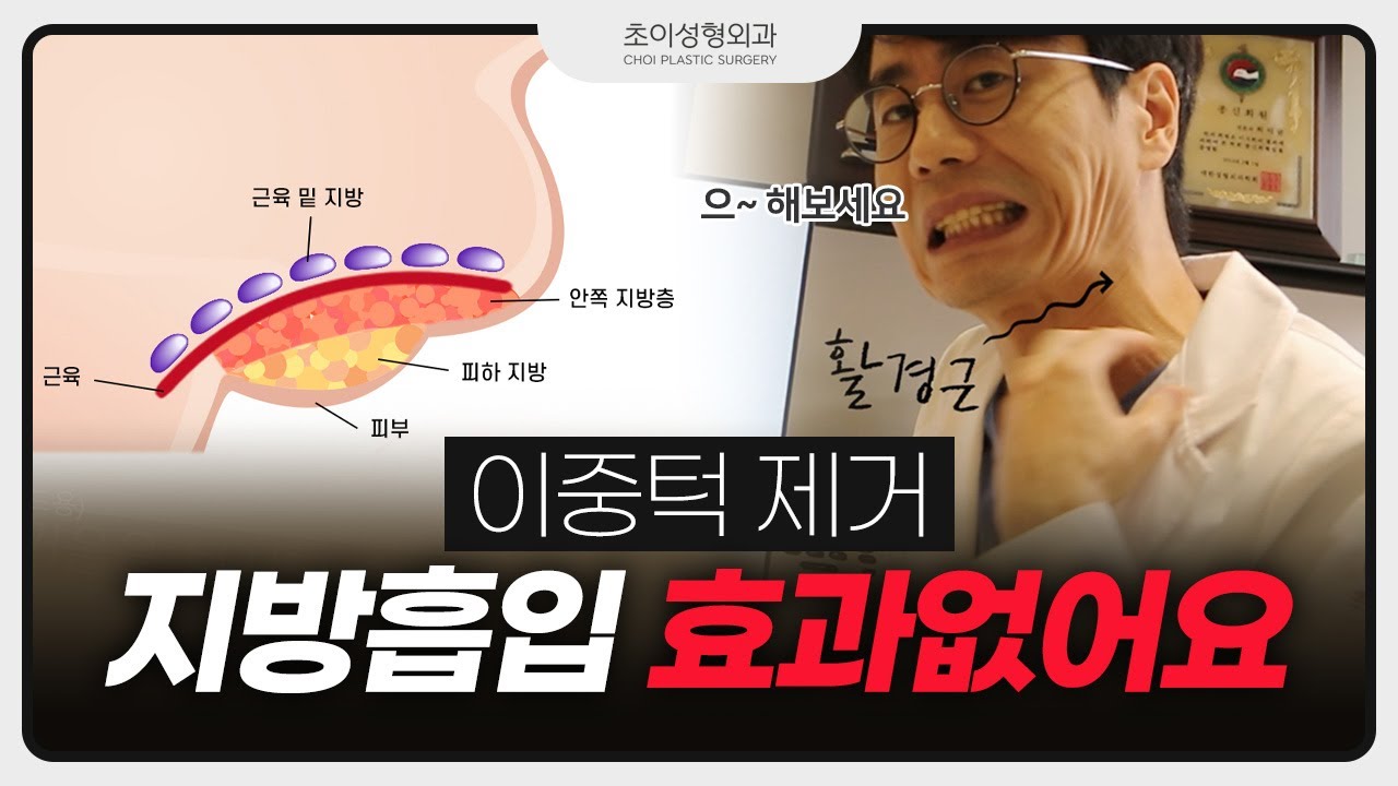 이중턱지방흡입 효과가 왜 없을까? 코르셋이중턱(이중턱근육묶기, 목거상)