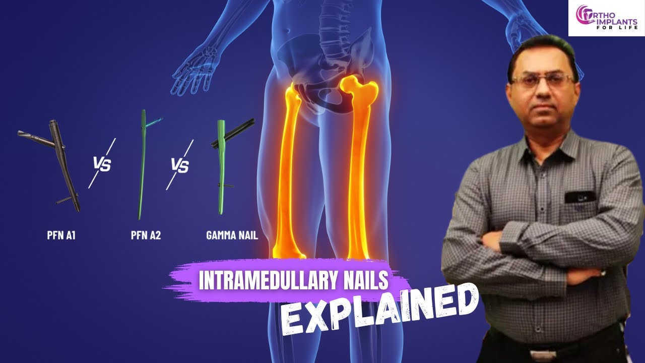 PFN A1 vs PFN A2 vs Gamma Nail - Which Intramedullary Nail Does What?