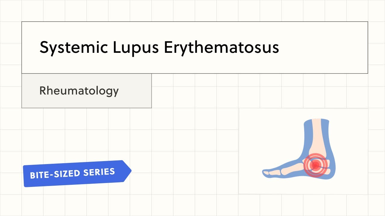 Systemic Lupus Erythematosus