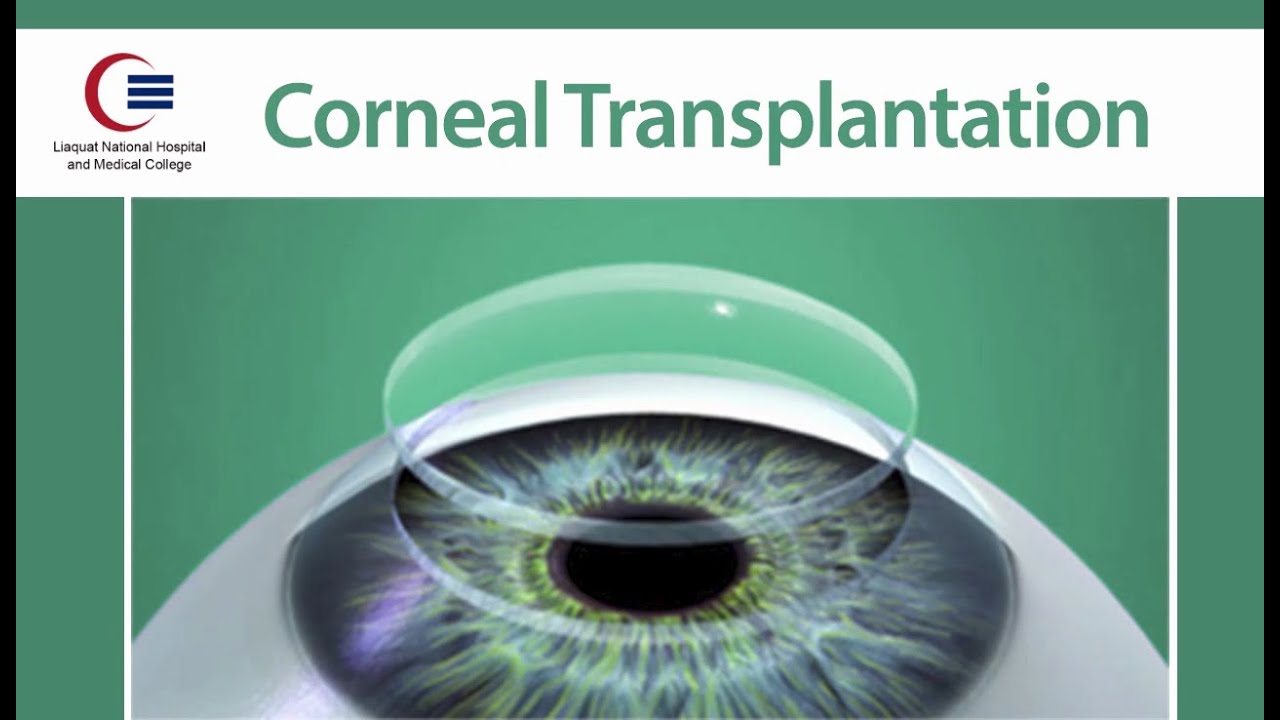 Corneal Transplantation by Dr. Tanveer Chaudhry