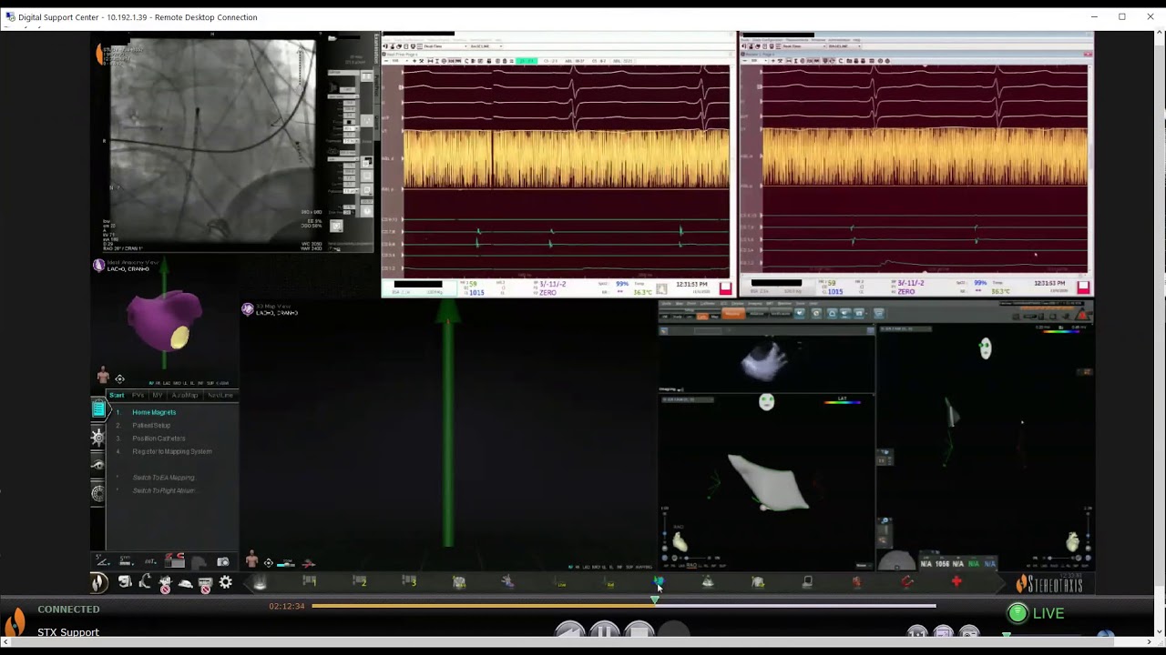 Dr. Benjamin D'Souza Navigating in the Left Atrium for a Recurrent Complex LA Ablation