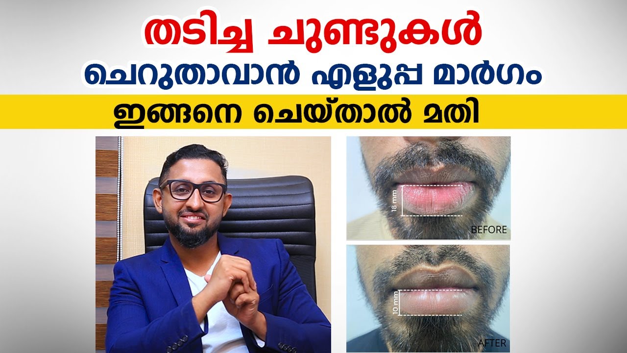 തടിച്ച ചുണ്ടുകൾ ചെറുതാവാൻ എളുപ്പ വഴി | reduce lip size | Dr varun Nambiar