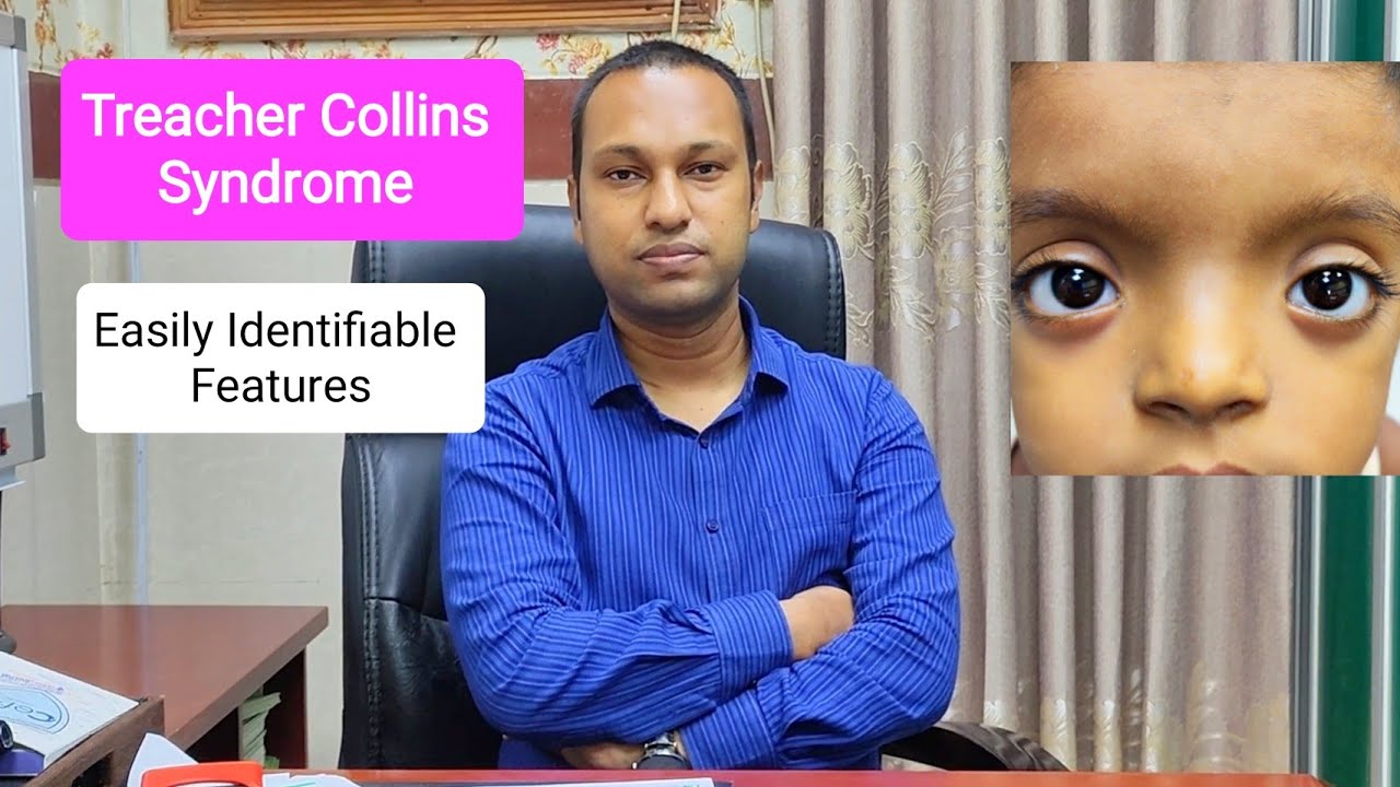 Treacher Collins Syndrome: Learn Easily Identifiable Features