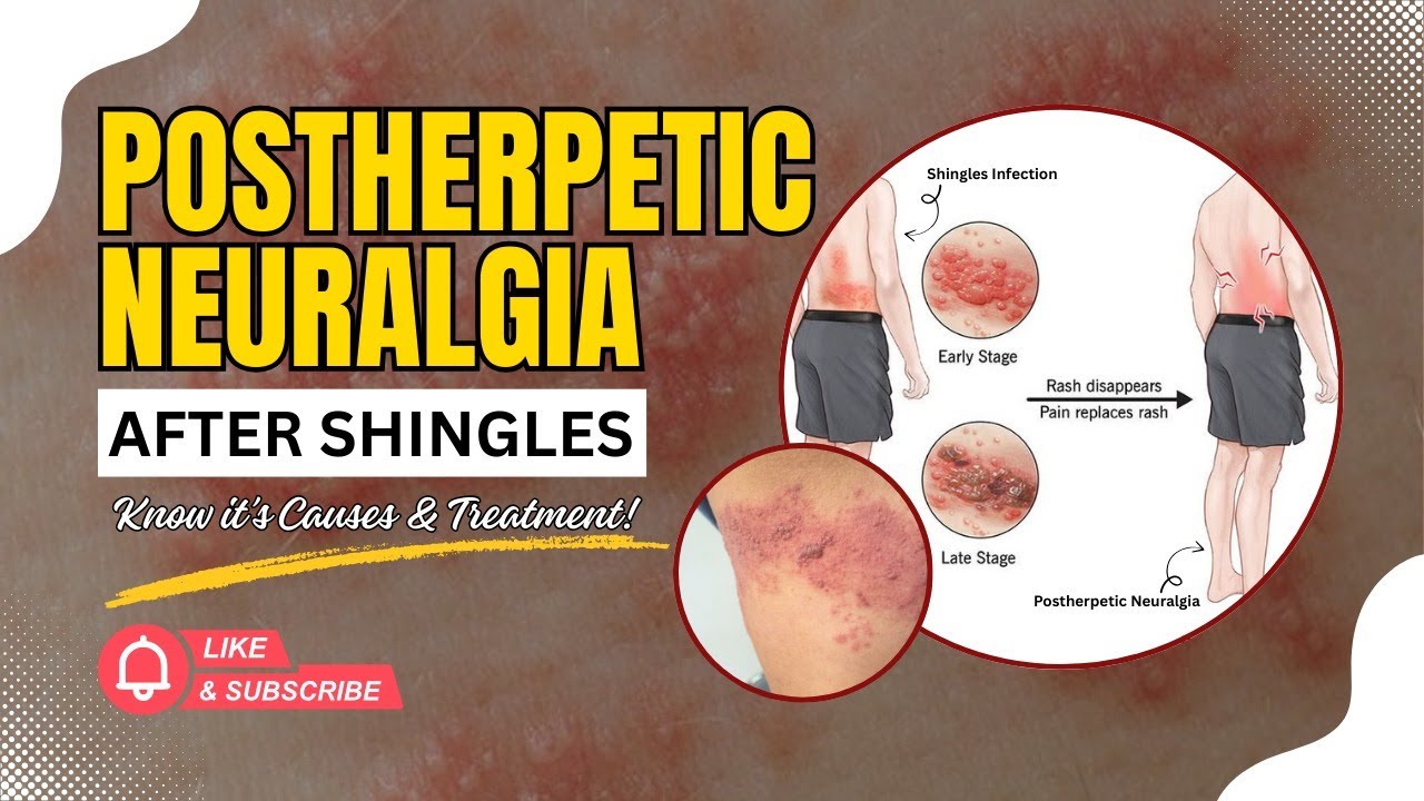 Postherpetic Neuralgia: Symptoms, Causes, Treatment & Prevention After Shingles