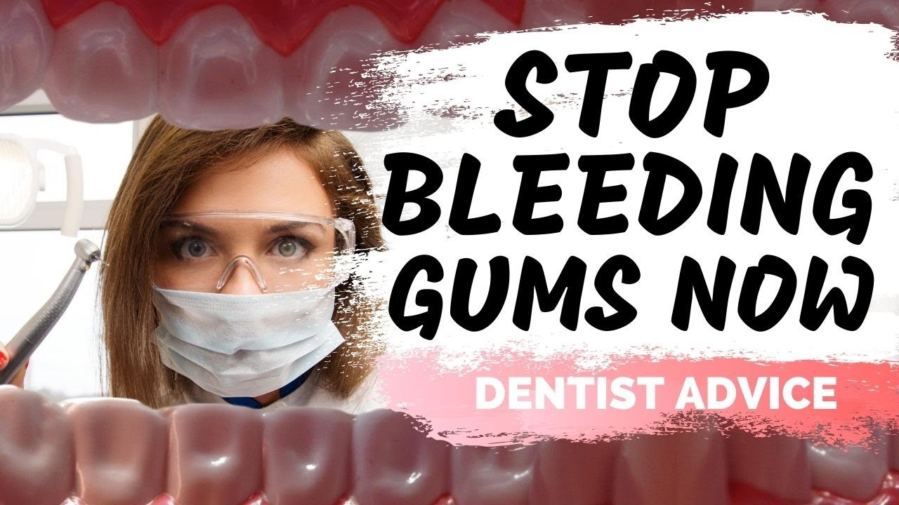 How to STOP Bleeding Gums | Treatment for Periodontal Disease