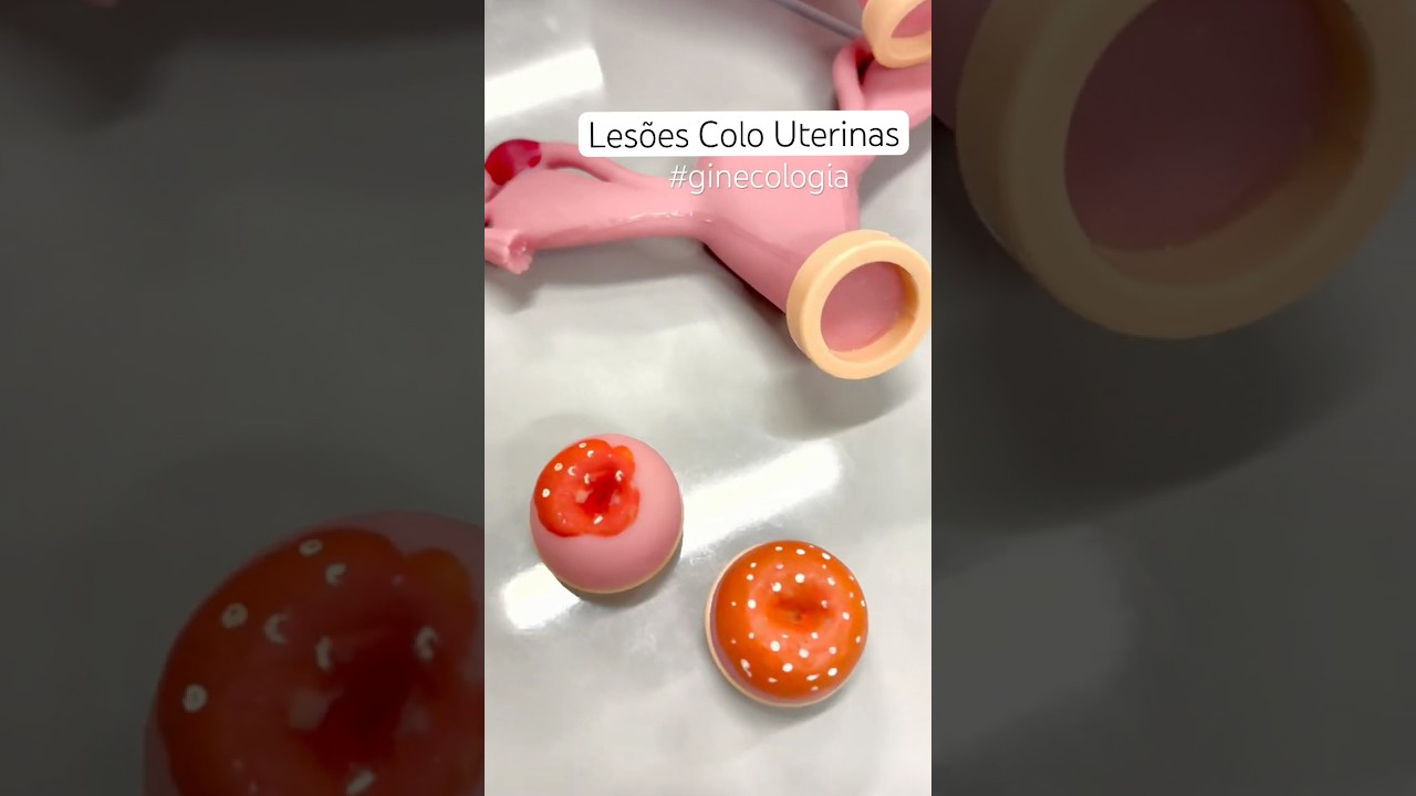 Les&otilde;es de Colo de &uacute;tero - aula pr&aacute;tica de sa&uacute;de da mulher. #medstudent #ginecologia #colodoutero