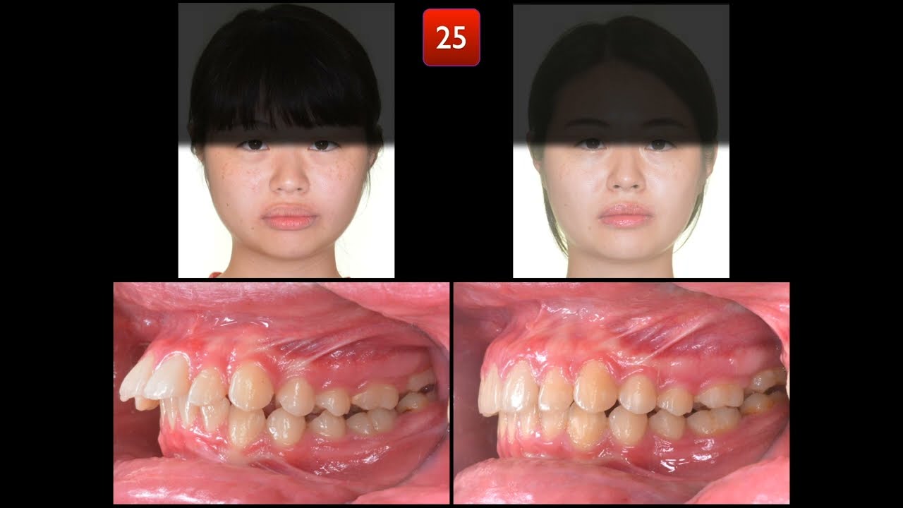 Solving Huge Overjet and Deepbite with Aligners｜【Chris Chang Ortho】CC644