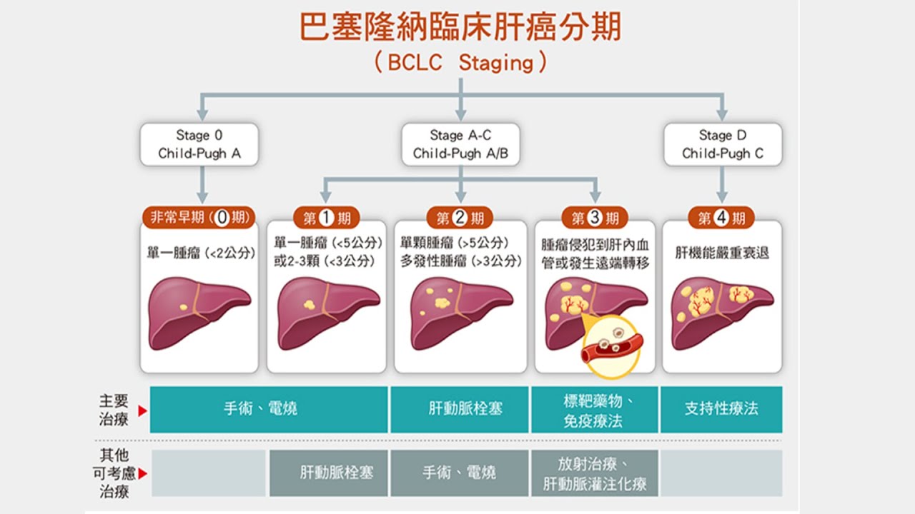 【名醫妙方】認識各種治療肝癌的方法 2022.06.13