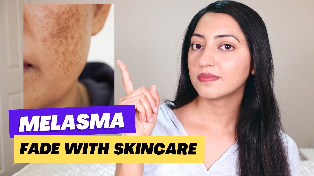 How to Remove Melasma, Pigmentation with Skincare