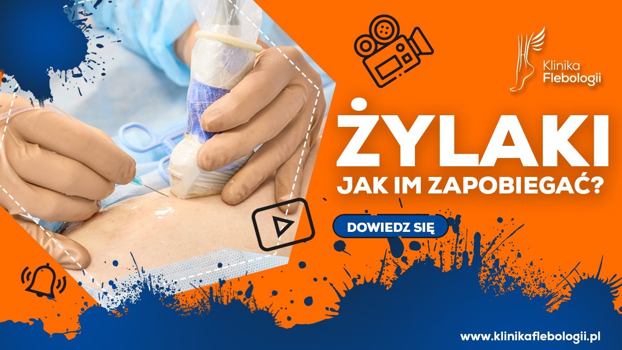 ŻYLAKI - jak im zapobiegać?