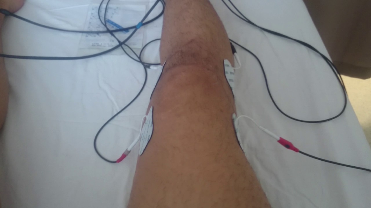 ÖN ÇAPRAZ BAĞ AMELİYATI (ACL SURGERY) SONRASI HASTANEDE FİZİK TEDAVİ 1. GÜNÜM