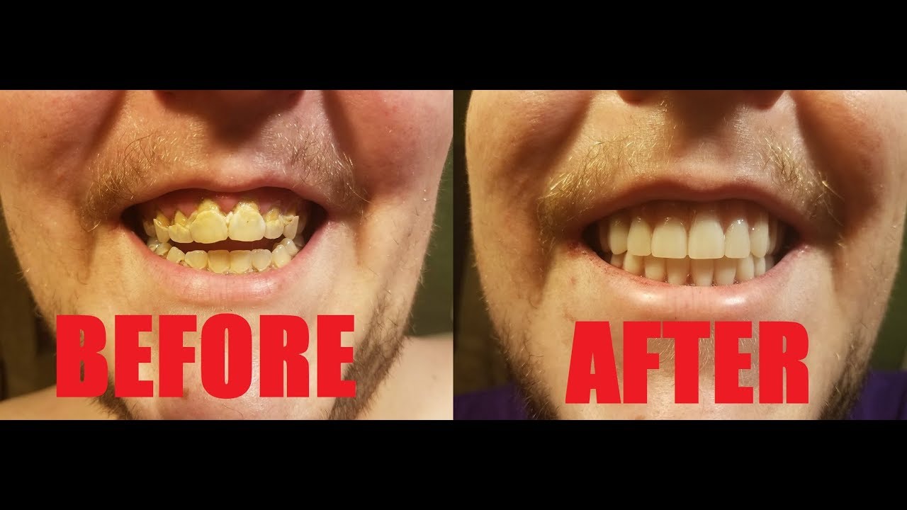 Eday/Day 1: Before and After Dentures - Denture Vlog
