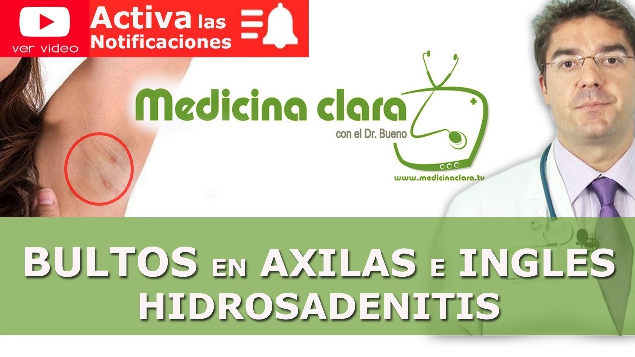 BULTOS en las AXILAS e INGLES | Golondrinos | Hidrosadenitis