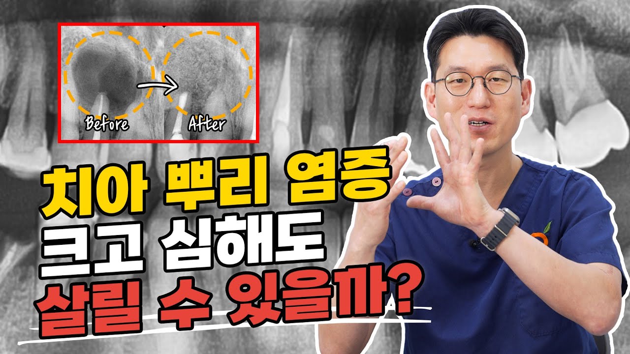 치아 뿌리 염증이 이렇게나 크다고?! 😨 발치해야 할까봐 걱정되시죠? 아무리 큰 치아뿌리염증도 치근단절제술로 해결 가능합니다 👍