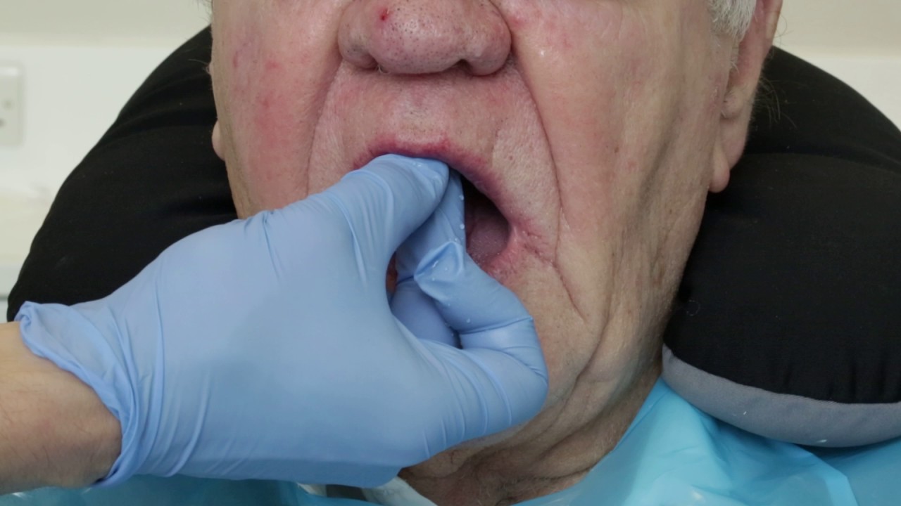 Verification of peripheral seal of&nbsp;border moulded special&nbsp;tray for complete denture.