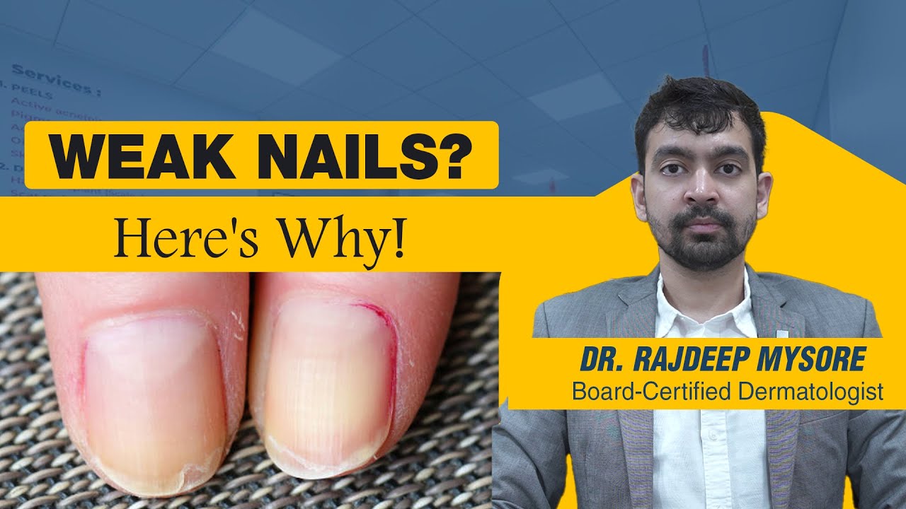 Weak Nails: Genetic or Nutritional? Find Out! - Dr. Rajdeep Mysore | Charma Clinic