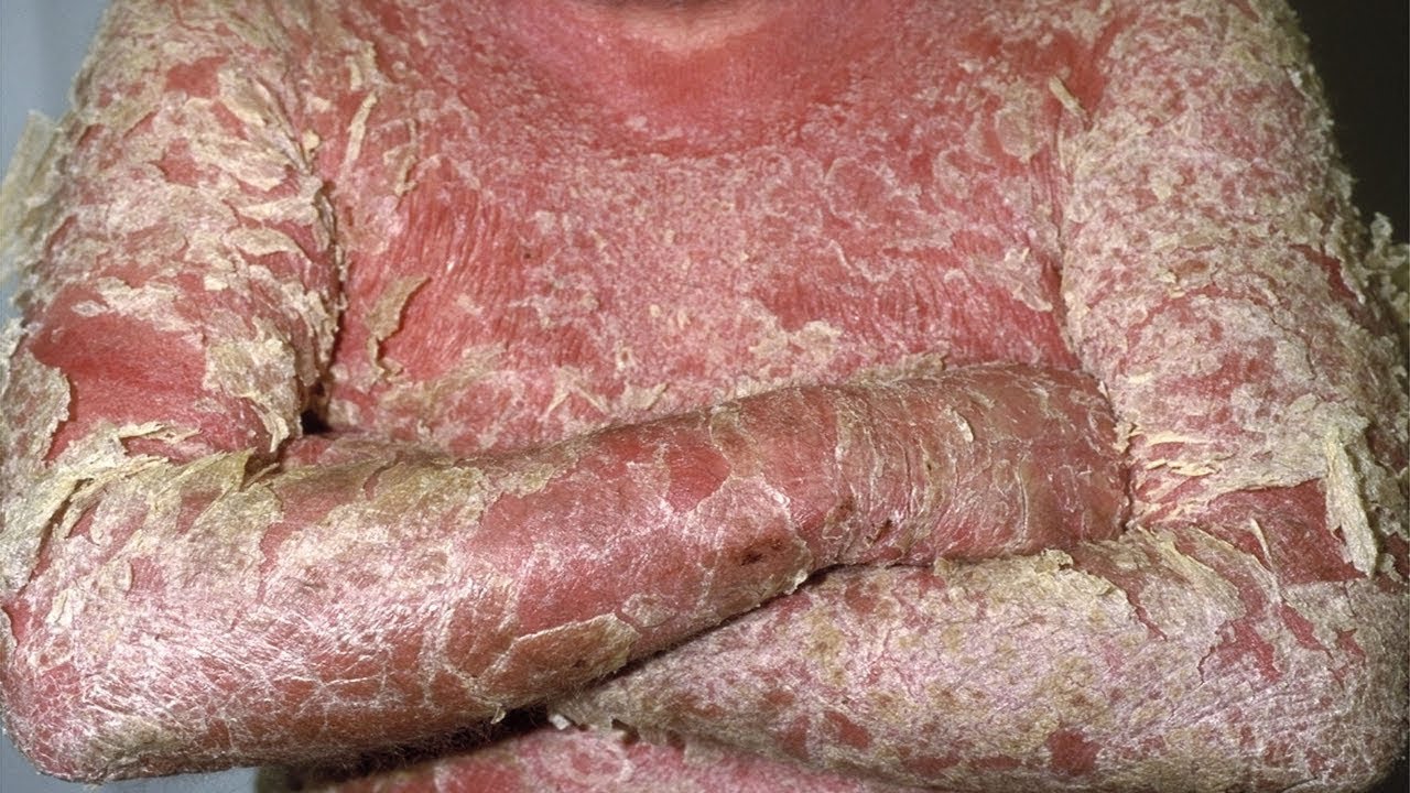 സോറിയാസിസ് എന്ത് എങ്ങനെ?│Psoriasis: Causes and Cure | DOCTOR Q│News18 Kerala