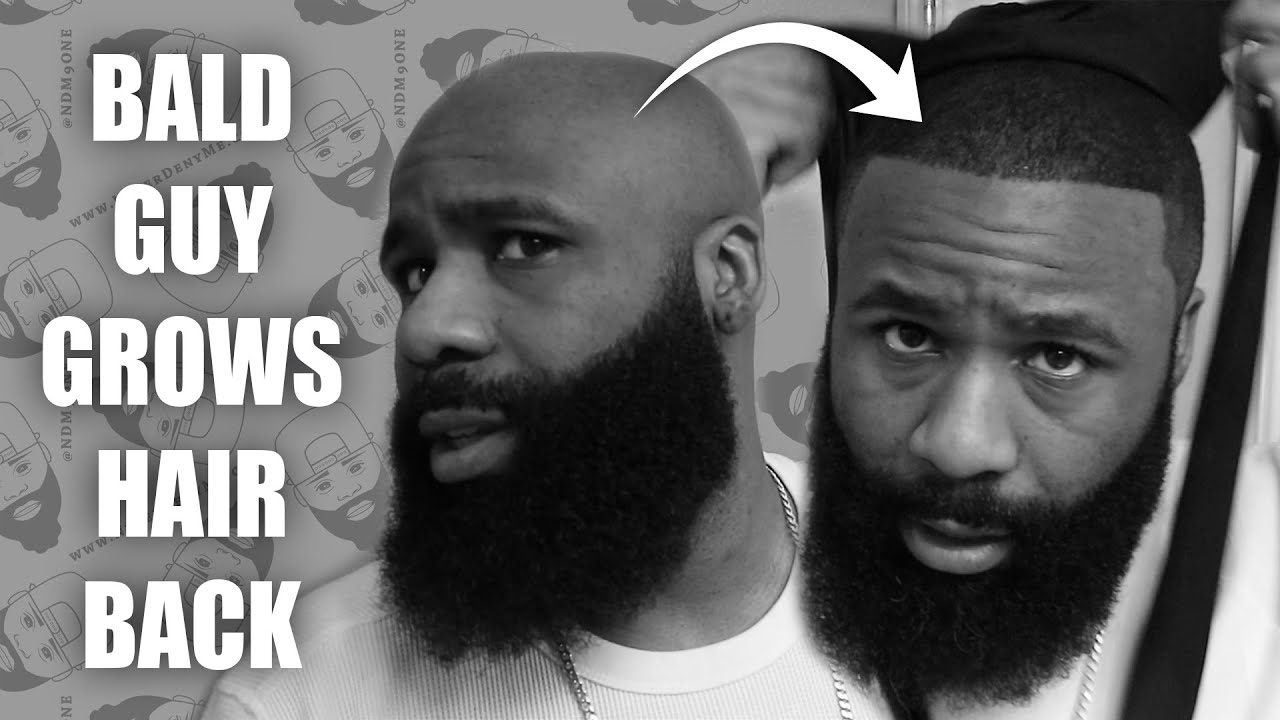 HAIR REGROWTH ❗ | Bald Guy Grows Hair Back 👩🏽‍🦲 | Hair Loss Prevention Remedies 💈 | @NateMatthews
