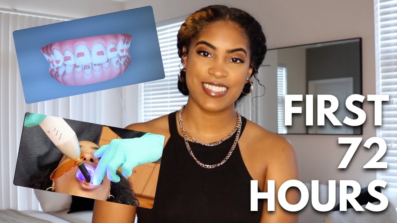 my first 72 hours with invisalign | cost + pain level + expectations