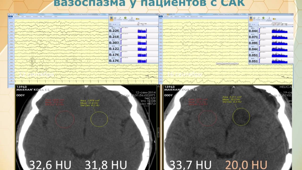 EEG мониторинг в отделении нейрореанимации Кристина Лаптева