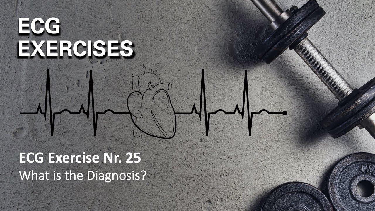 ECG Exercise 25: what is the mechanism of the epsilon like wave?