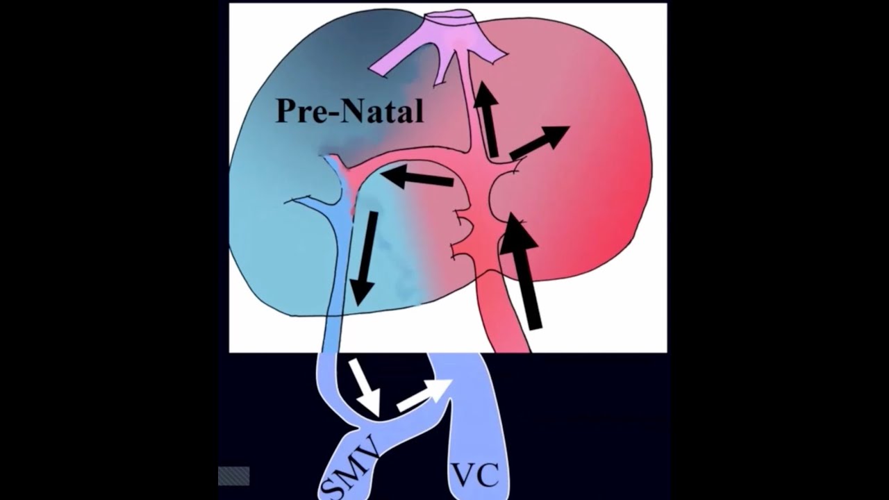 Abernethy  congenital shunt