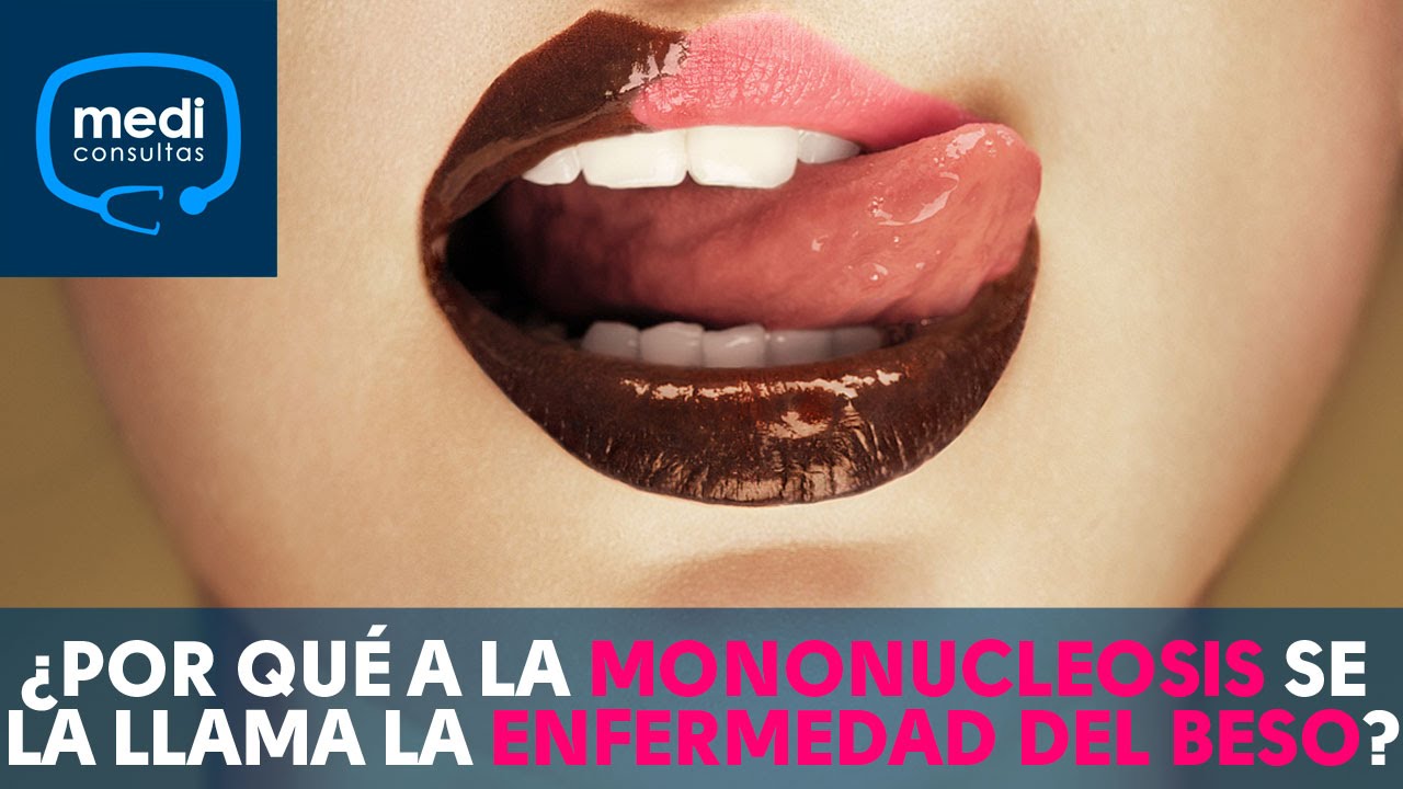 &iquest;Por qu&eacute; a la mononucleosis se la llama enfermedad del beso? #MediConsulta
