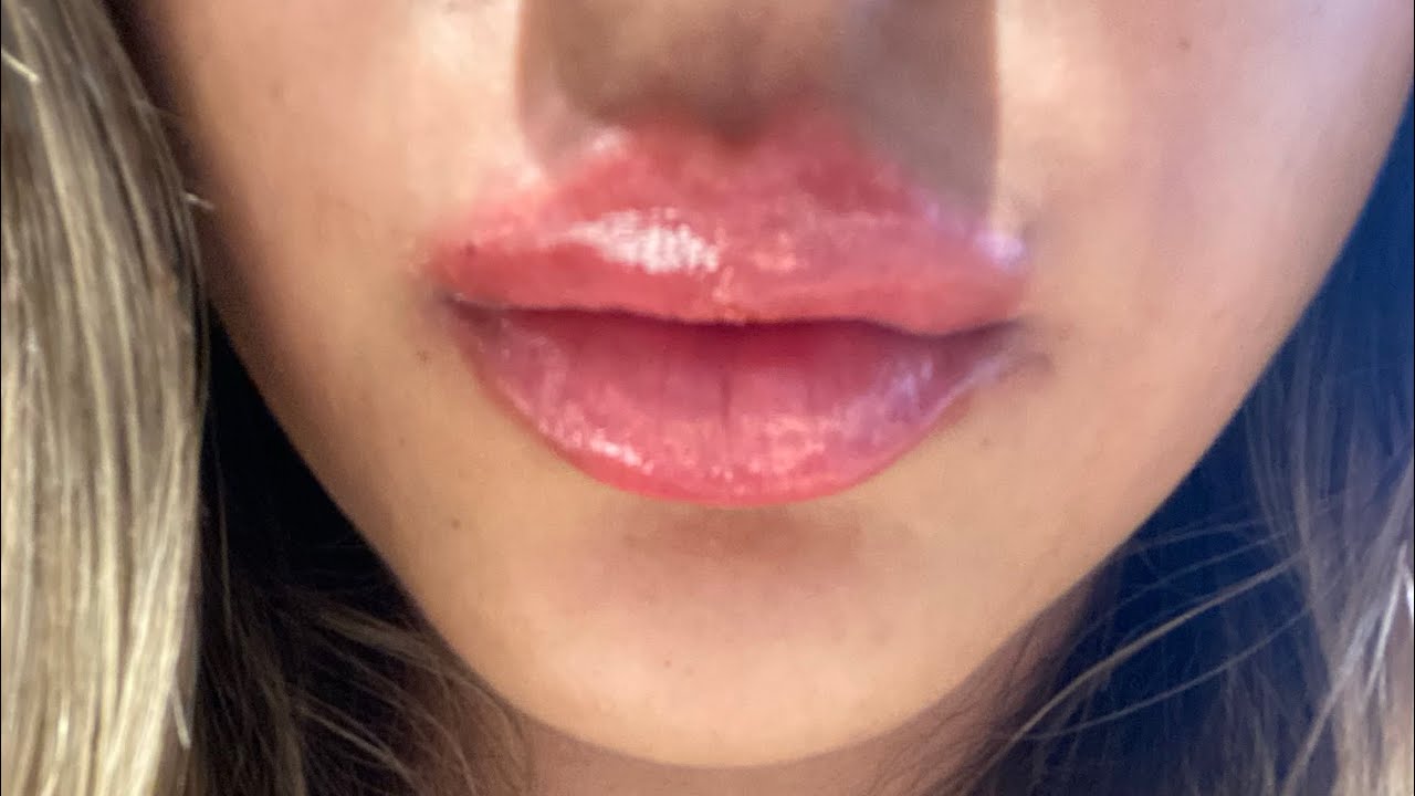 DUDAK DOLGUSU YAPTIRDIM!👄