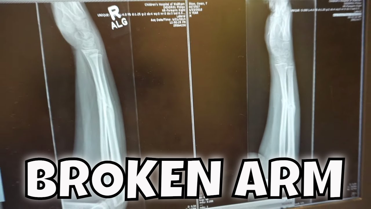 OWEN GETS CRAZY NEWS ABOUT HIS BROKEN ARM!