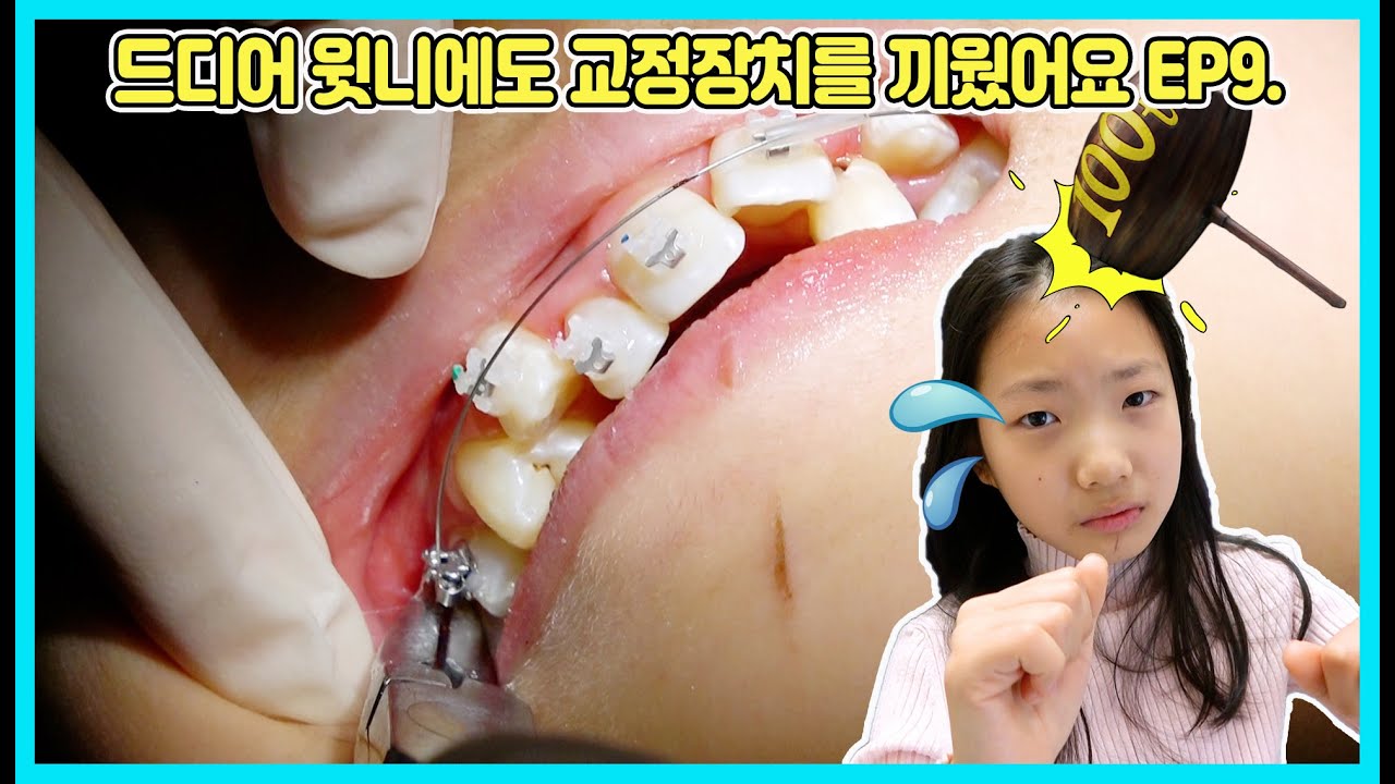 [치아교정EP9] 드디어 윗니도 치아 교정장치를 했어요! 이제 남아 있는 치료는 윗니 2개를 뽑는 일만 남았어요 ㅠㅠ [사랑아놀자 LOVE&TORY]