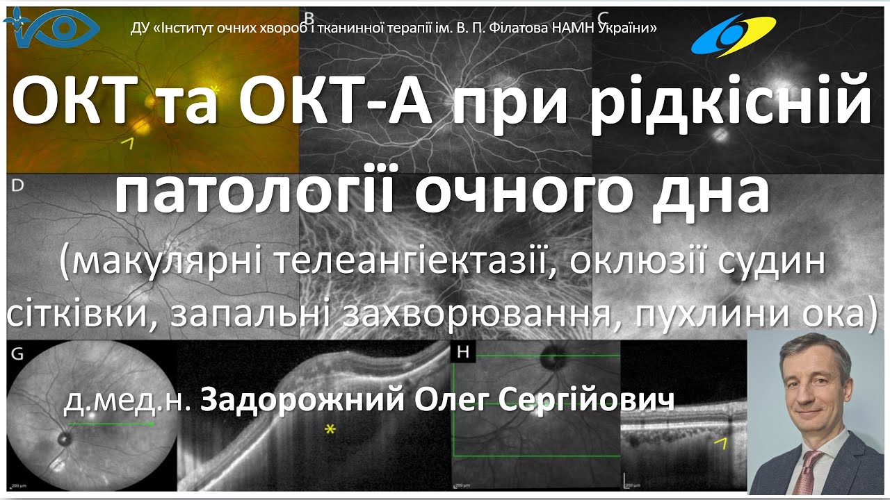 ОКТ і ОКТ-А при макулярних телеангіектазіях, оклюзіях судин, запальних захворюваннях, пухлинах