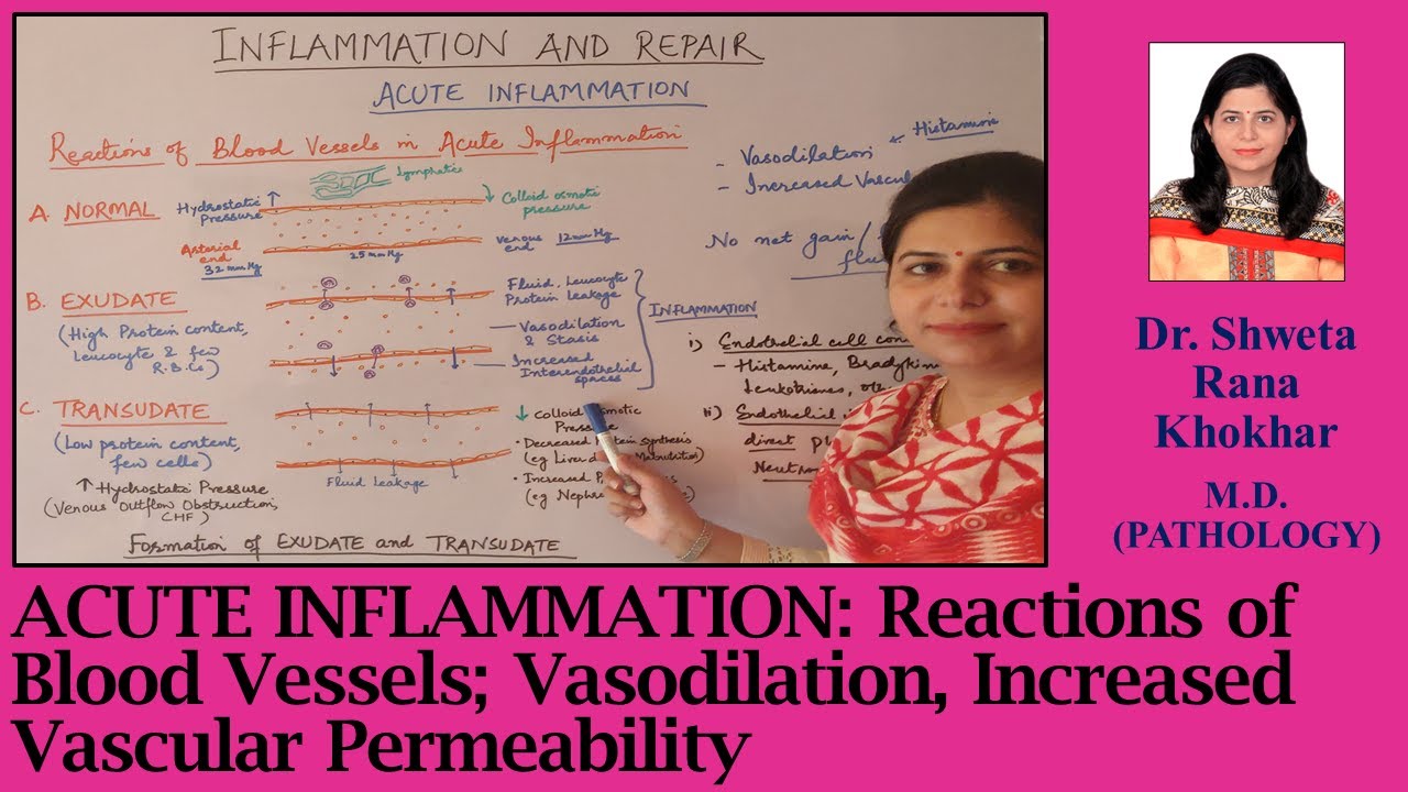 Acute Inflammation: Reactions of Blood Vessels; Vasodilation,  Increased Vascular Permeability