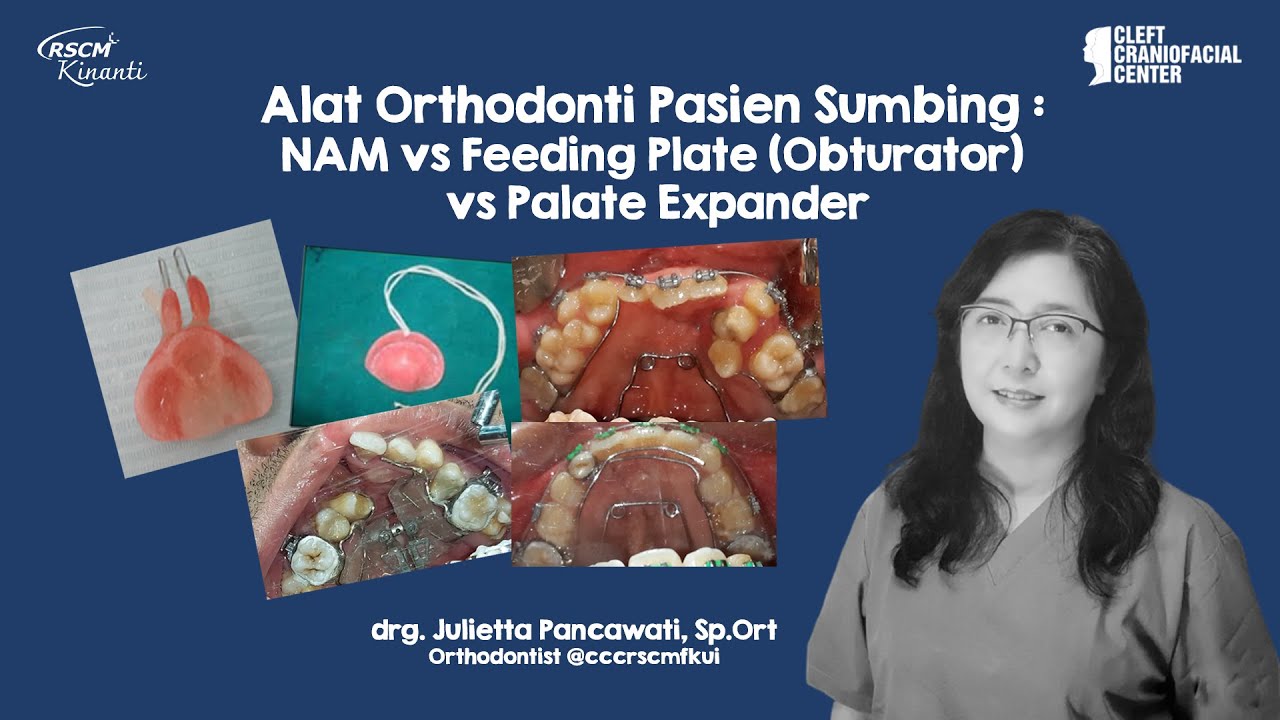 Alat Orthodonti Pasien Sumbing : NAM vs Feeding Plate (Obturator) vs Palate Expander
