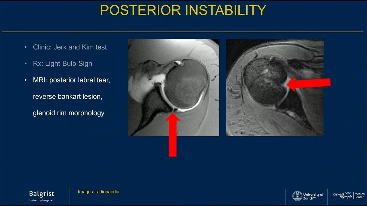 Balgrist erklärt: Schulterinstabilität | Shoulder Instability