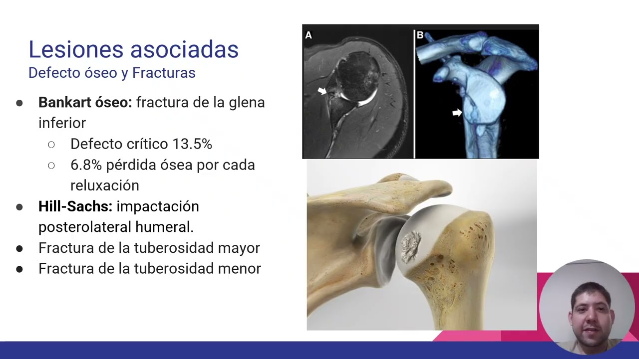 Inestabilidad Anterior de Hombro