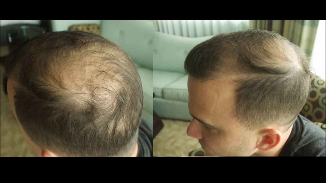 Jason talks about his life before and after Micro Scalp Pigmentation with Vinci Hair Clinic
