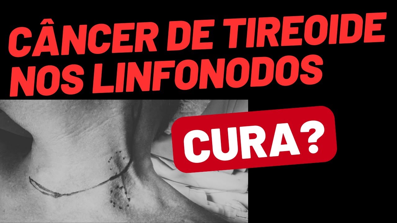 Câncer de tireoide com linfonodos: ainda tem cura?